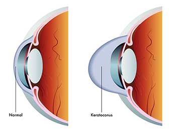 keratoconus